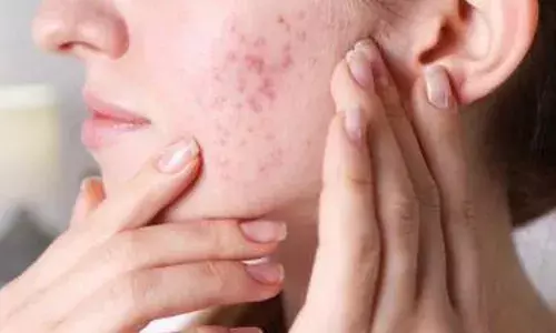 बारिश में पिंपल्स से रहते हैं परेशान, तो ये टिप्स आएंगी आपके काम