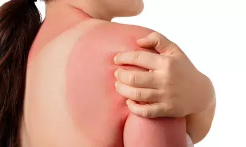 अगर आप भी हैं सनबर्न से परेशान, तो एलोवेरा जेल के ये फेस मास्क्स को करें ट्राई, कुछ ही दिनों में मिल जाएगा आराम