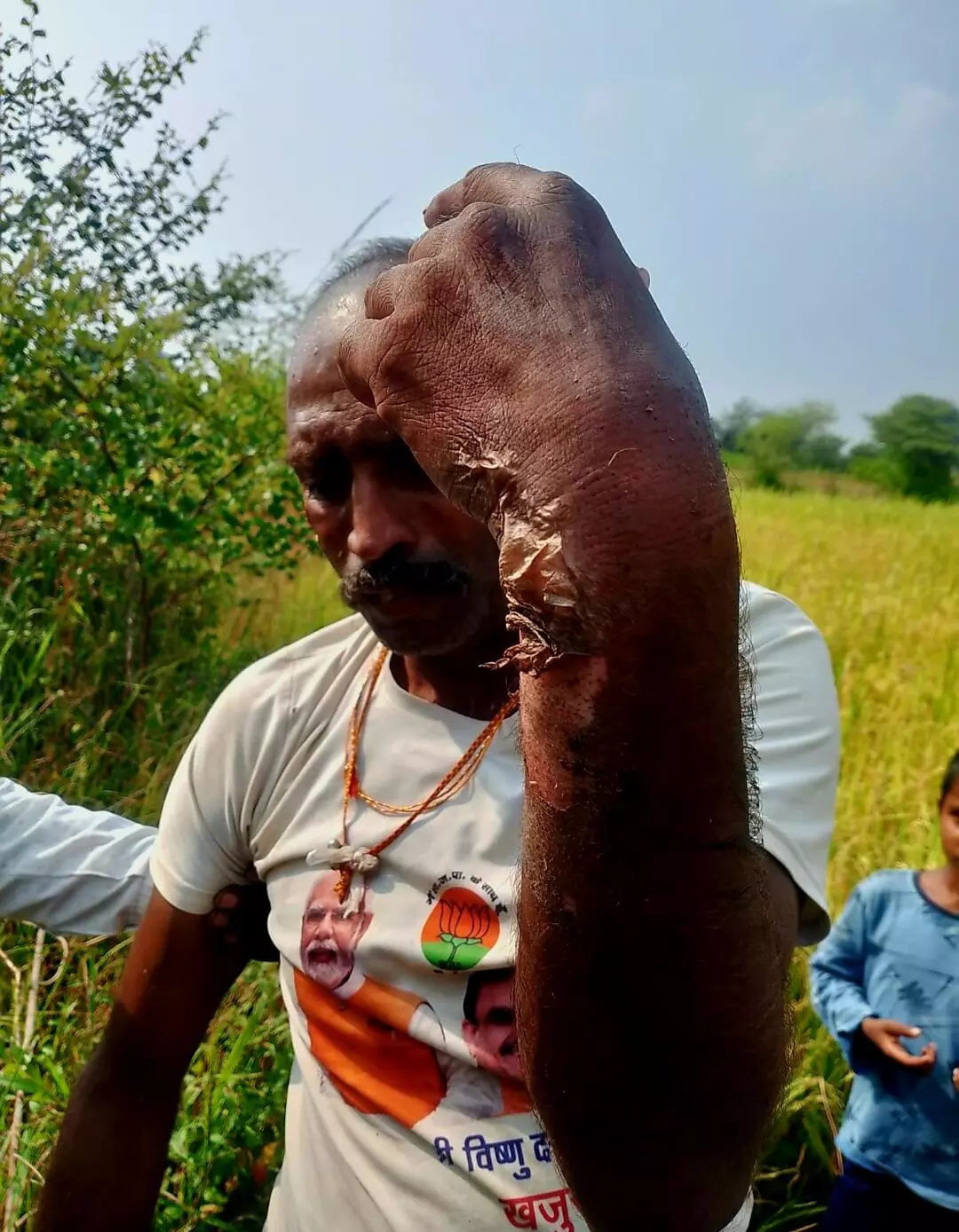 हाईटेंशन लाइन की चपेट में आया किसान झुलसा, हालत में सुधार हाईटेंशन लाइन की चपेट में आया किसान झुलसा, हालत में सुधार