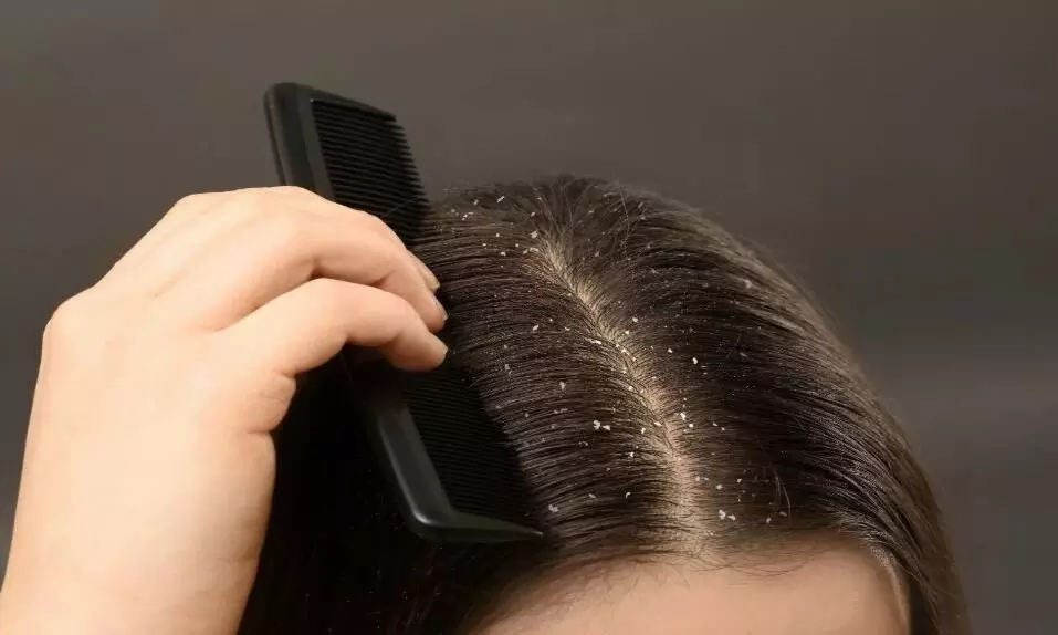 ठंड के मौसम की एंट्री से पहले ही आने लगे हैं डैंड्रफ, तो इन घरेलू उपायों को जरूर करें ट्राई ठंड के मौसम की एंट्री से पहले ही आने लगे हैं डैंड्रफ, तो इन घरेलू उपायों को जरूर करें ट्राई