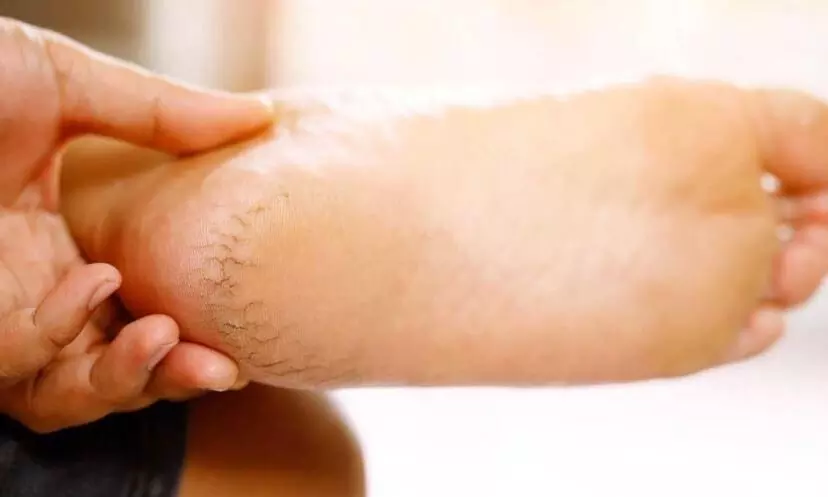 सर्दियों में एड़ी फटने से रहते हैं परेशान, तो ये 3 होम रेमेडी आएंगी काम, महंगे प्रोडक्ट्स को कहिए Bye सर्दियों में एड़ी फटने से रहते हैं परेशान, तो ये 3 होम रेमेडी आएंगी काम, महंगे प्रोडक्ट्स को कहिए Bye