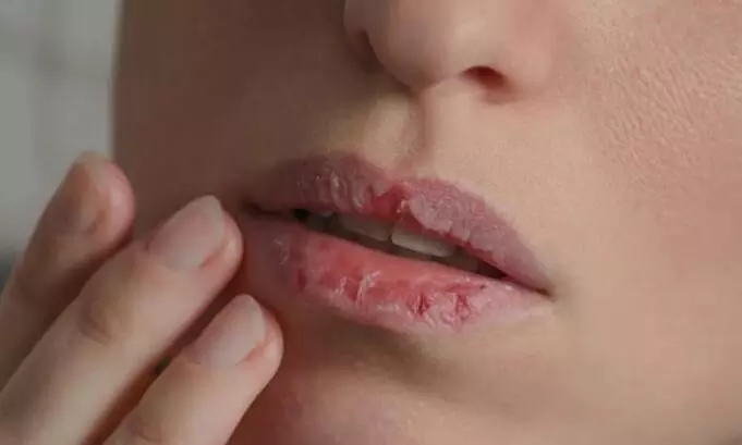 सर्दियों में फटने लगते हैं आपके भी होंठ, तो इन घरेलू टिप्स को जरूर करें उपयोग