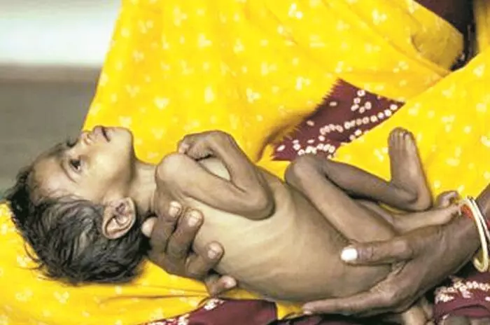 मेलघाट से रेफर मरीज कुपोषण से जुड़ी बीमारियाें से होते हैं पीड़ित मेलघाट से रेफर मरीज कुपोषण से जुड़ी बीमारियाें से होते हैं पीड़ित