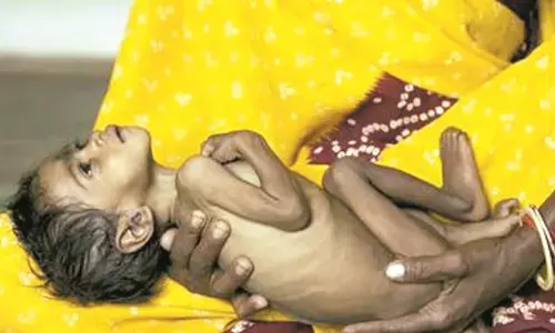 मेलघाट से रेफर मरीज कुपोषण से जुड़ी बीमारियाें से होते हैं पीड़ित मेलघाट से रेफर मरीज कुपोषण से जुड़ी बीमारियाें से होते हैं पीड़ित