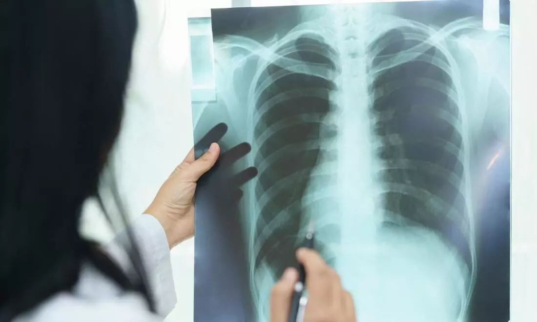 प्रदूषण से बढ़ रहा फेफड़े के कैंसर का खतरा, धुआं, धूल-मिट्टी से हो रहा बुरा असर प्रदूषण से बढ़ रहा फेफड़े के कैंसर का खतरा, धुआं, धूल-मिट्टी से हो रहा बुरा असर