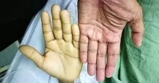 सालभर में 30 लोग अप्लास्टिक एनीमिया से पीड़ित, आरबीसी- डब्ल्यूबीसी और प्लेटलेटस् की संख्या कम