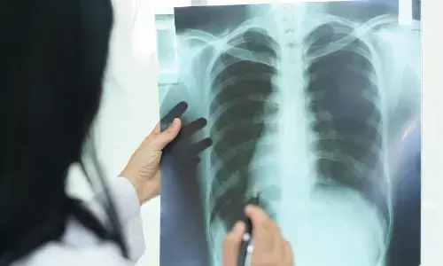 प्रदूषण से बढ़ रहा फेफड़े के कैंसर का खतरा, धुआं, धूल-मिट्टी से हो रहा बुरा असर