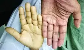 सालभर में 30 लोग अप्लास्टिक एनीमिया से पीड़ित, आरबीसी- डब्ल्यूबीसी और प्लेटलेटस् की संख्या कम