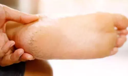 फटी हुई एड़ियों से हैं परेशान? तो इन उपायों से बनाएं बेबी सॉफ्ट हील्स फटी हुई एड़ियों से हैं परेशान? तो इन उपायों से बनाएं बेबी सॉफ्ट हील्स