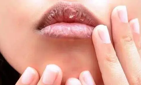 ठंड के मौसम में आप भी रहते हैं फटे होठों से परेशान? तो इन घरेलू उपायों का जरूर करें इस्तेमाल