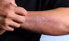 कॉर्पोरेट स्ट्रेस बना त्वचा रोगों का बड़ा कारण, हर दूसरा कर्मचारी पीड़ित, सबसे ज्यादा प्रभावित युवा प्रोफेशनल्स