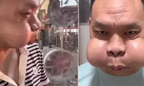 30 साल तक किया फूंक मारने का काम, तो अजीब से फूल गए गाल, जानकर लोग हुए हैरान