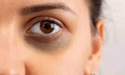 सोने के बाद भी डार्क सर्कल्स से नहीं मिल रहा है आराम, तो इन टिप्स का करें इस्तेमाल