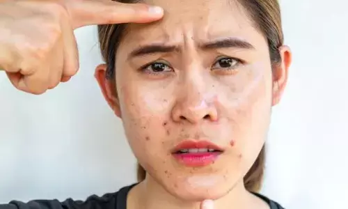 महंगे प्रोडक्ट्स लगाए लेकिन अब भी ऑयली स्किन से परेशान? इन घरेलू नुस्खों को भी  जरूर करें ट्राई