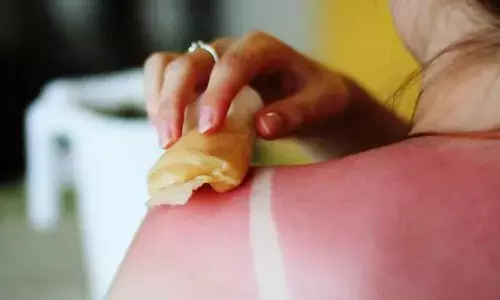 गर्मियों में अपनी त्वचा को सनबर्न से बचाने के लिए इन बातों का रखें खास ख्याल, यहां देखें टिप्स