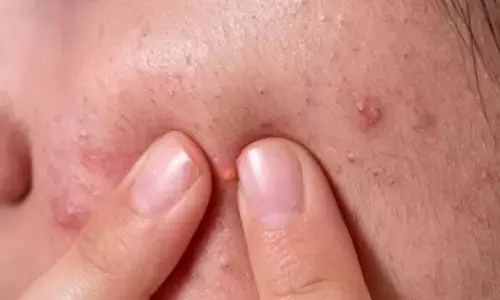 गर्मियों में बढ़ रहे हैं पिंपल्स, तो इन घरेलू उपायों का इस्तेमाल कर अपने चेहरे को करें साफ