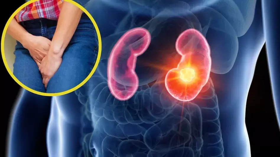 किडनी की बीमारियों से बचाव के लिए जागरुकता अभियान, नेफ्रोलॉजी सोसाइटी और एकेडमी ऑफ मेडिकल साइंसेज की पहल